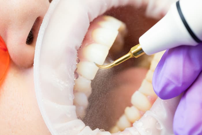 Ortodontik Tedavide Diş Eti Sağlığının Önemi