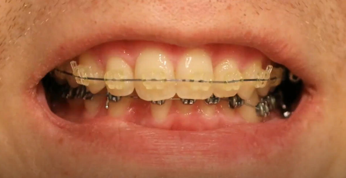 Tam Kapanış Pozisyonunda Diş Tellerinin Dişleri Hareket Ettirmesi