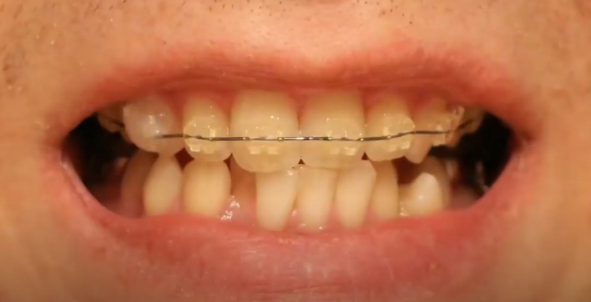 Uc Uca Pozisyonunda Diş Tellerinin Dişleri Hareket Ettirmesi