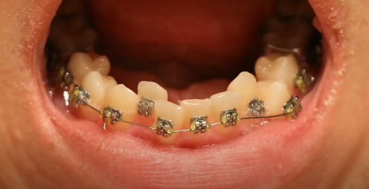 Alt Dişler Diş Tellerinin Dişleri Hareket Ettirmesi