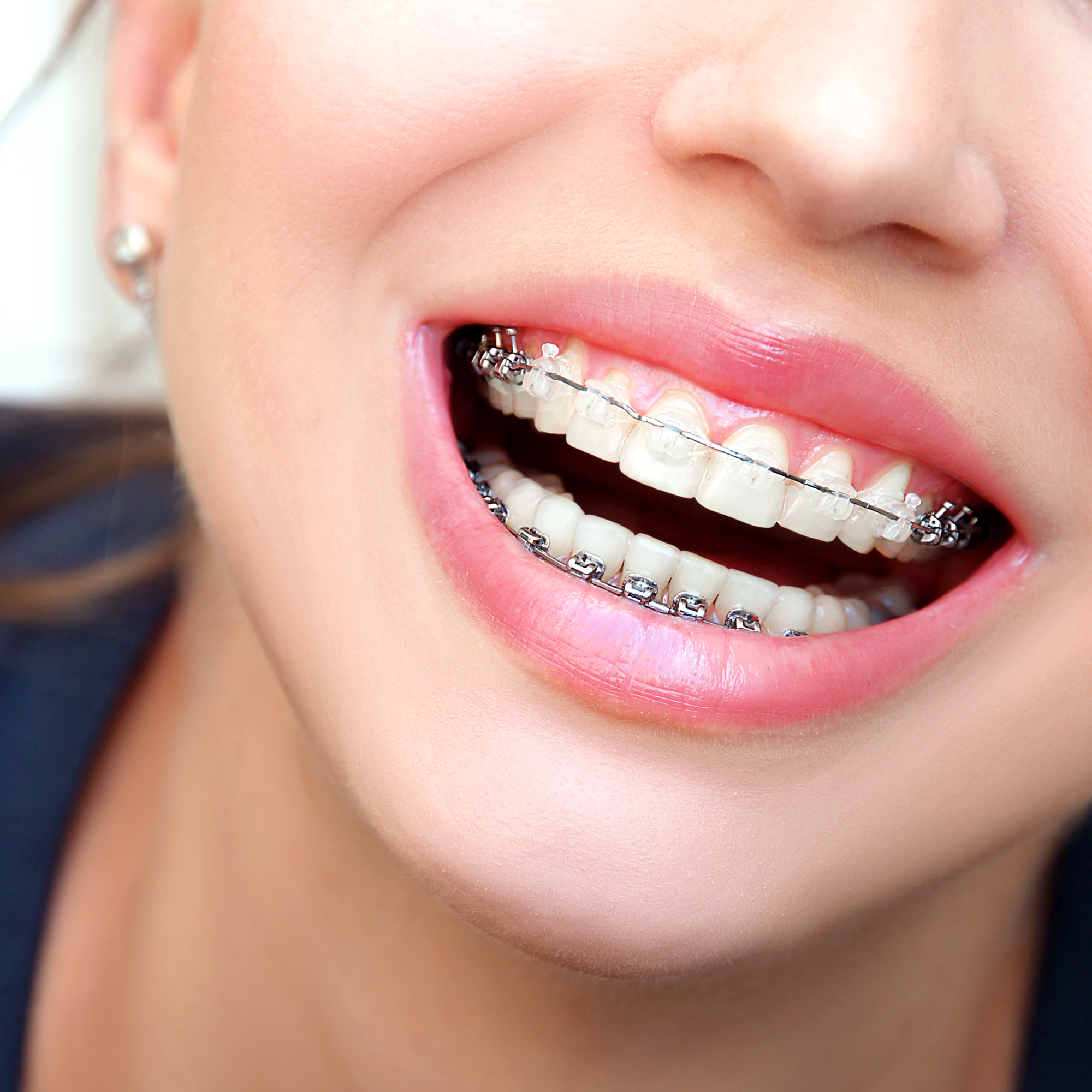 Ortodontik Tedavi Sürecimi Nasıl Kısaltırım?
