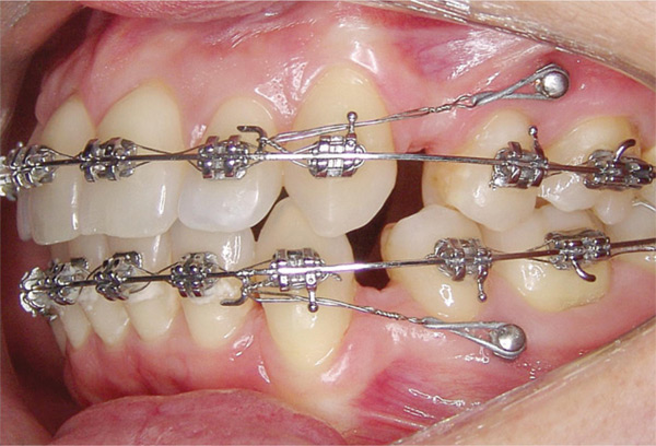Ortodontik Tedavilerde Mini Vida Kullanımı