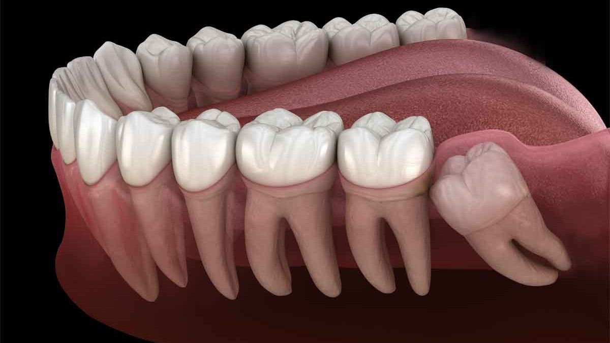 20 Yaş Dişleri ile Ortodontik Tedavi İlişkisi