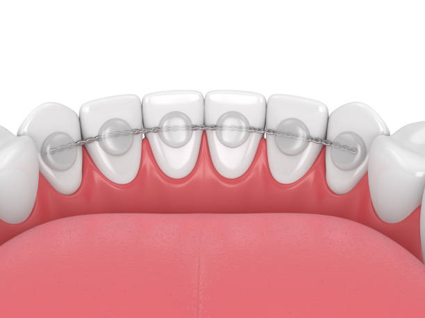 Ortodontik Tedavi Sonu Teli (Retainer Teli)